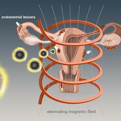 endometriosis treatment