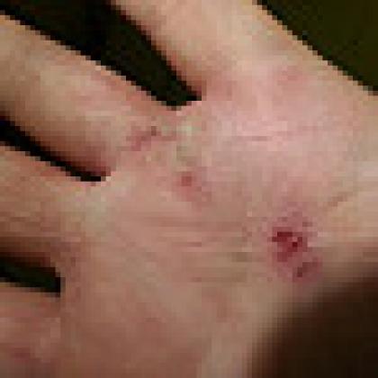Atopic dermatitis