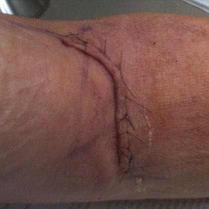 surgical incision
