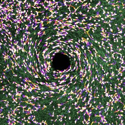 cancer and collagen fibers